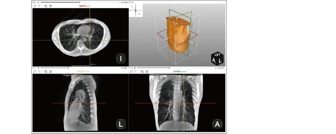 CTで撮影された肺の写真