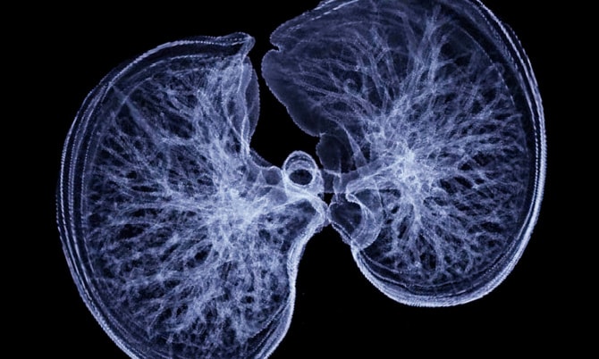 胸部CTで肺を5mm程度に薄切りした輪切りの写真